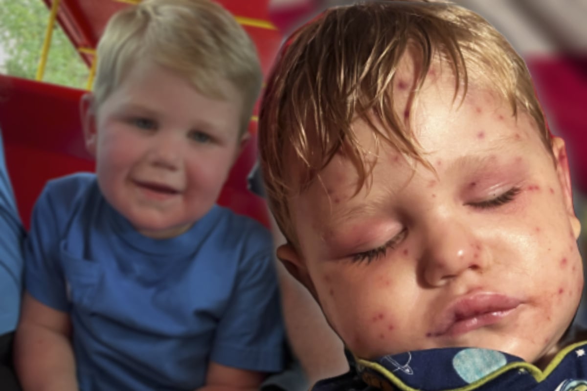 Wespen stechen kleine Jungen 150 Mal: Organe scheitern nach dem Horrorangriff