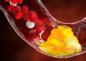 Herzinfarkt und Schlaganfall: „So natürlich wie Aspirin“ – das steckt hinter dem Cholesterin-Gefühl – WELT